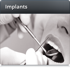 Image for Save On Implants with ID of: 1002797