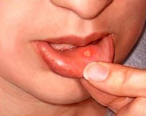 Image for Cures For Cold Sores with ID of: 1008408
