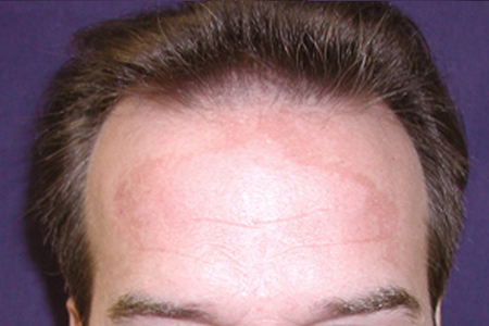 Image for Affordable Hair Transplants Cincinnati with ID of: 1028058