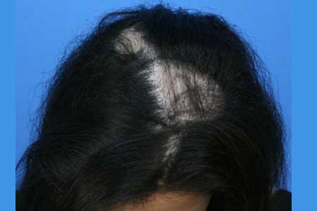 Image for Affordable Hair Transplants Boca Raton with ID of: 1031389