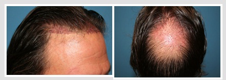 Image for Robotic Hair Transplants San Francisco with ID of: 1042995