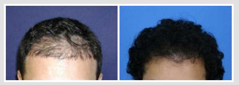 Image for Robotic Hair Transplants Cincinnati with ID of: 1051159