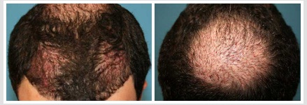 Image for Robotic Hair Transplants Melbourne with ID of: 1054166
