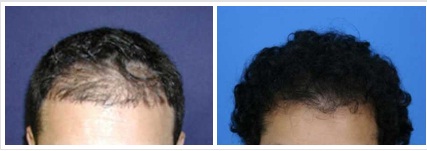 Image for Affordable Hair Transplants San Francisco with ID of: 1089049
