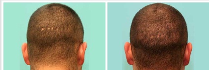 Image for Affordable Hair Transplants San Francisco with ID of: 1089050