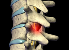 Image for Spine Surgery Cost in India with ID of: 1099598