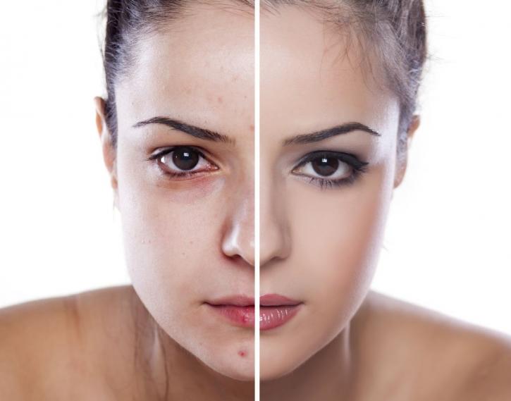 Image for Most effective acne treatment with ID of: 1106024