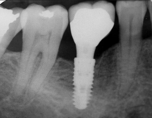 Image for Impeccable Dental Implants with ID of: 1130386