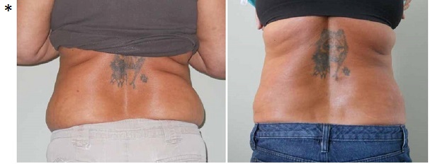 Image for Body contouring surgery in a massive weight loss patient with ID of: 1160355