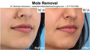 Image for Mole Extermination with ID of: 1162640