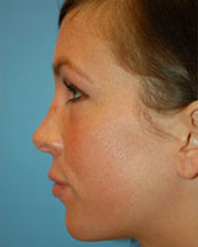 Image for The Seattle Rhinoplasty Center with ID of: 1182176