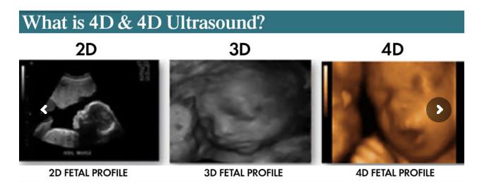 Image for Ultrasound and Sonogram - First Look Sonogram with ID of: 1202025