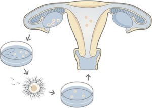 Image for In Vitro Fertilisation with ID of: 1242860