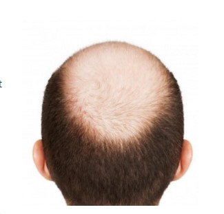 Image for Hairlossable with ID of: 1271964