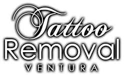 Image for Tattoo Removal Ventura with ID of: 1293650