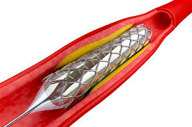 Image for Vascular Stents Market Volume Forecast and Value Chain Analysis 2016-2020 with ID of: 1302482