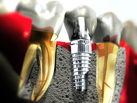 Image for These dental implants in Plainfield IL will make you smile radiant and wide! with ID of: 1321008