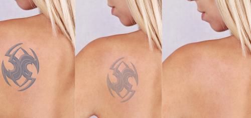 Image for InkAway Laser Tattoo Removal with ID of: 1336414