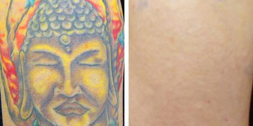 Image for InkAway Laser Tattoo Removal with ID of: 1336418