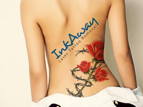Image for InkAway Laser Tattoo Removal with ID of: 1336421