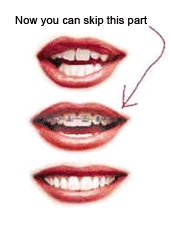 Image for Invisalign - Invisalign Procedure, Advantages & Disadvantages with ID of: 1346150