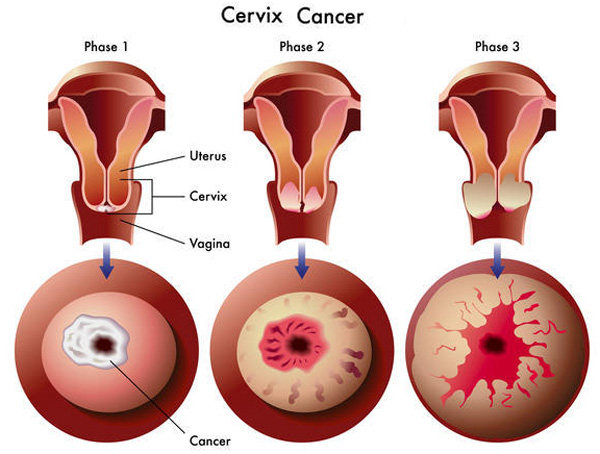 Image for cervical cancer diagnostics market segment forecast 2015-2021 with ID of: 1359016