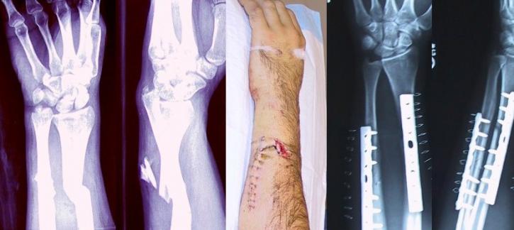 Image for Medical Devices : Bone Fixation Plates Analysis, Overview and Forecast with ID of: 1367135