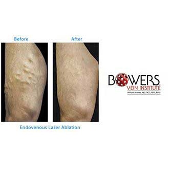 Image for Bowers Vein Institute with ID of: 1422091