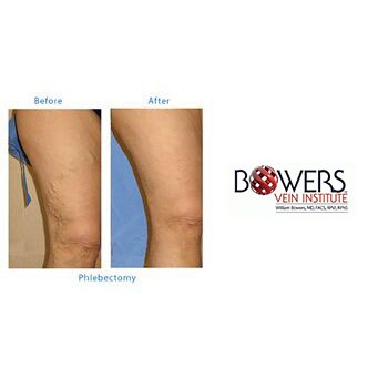 Image for Bowers Vein Institute with ID of: 1422092