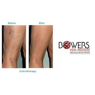 Image for Bowers Vein Institute with ID of: 1422093