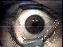 Image for Laser vision correction medford with ID of: 1457388