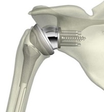 Image for Global Shoulder Replacement Devices Market 2016 Product Types,Sales,Price,Share and Growth 2021 with ID of: 1470204