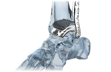 Image for Global Foot & Ankle Replacement Devices Market 2016 Product Types,Sales,Price,Share and Growth 2021 with ID of: 1470211