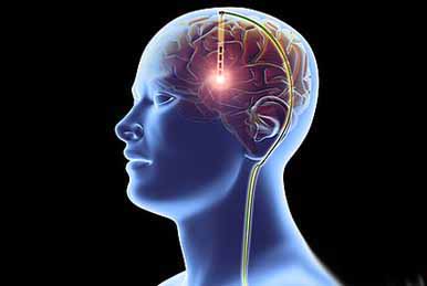 Image for Global Deep Brain Stimulators Sales Market 2016 Medtronic, Boston Scientific, Cerene Biomedics, Brainsway with ID of: 1489302