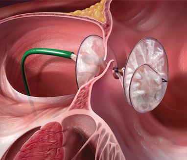 Image for Global Heart Defect Closure Devices Market 2016 - Occlutech, Starway, Boston Scientific Corp, LifeTech with ID of: 1489379