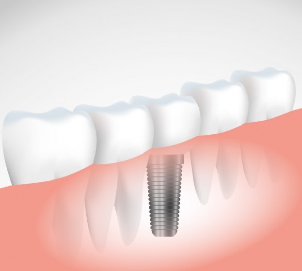 Image for Dental implants- Latest replacement option for missing teeth with ID of: 1546124