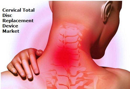 Image for Cervical Total Disc Replacement Device Market 2016 World Analysis and Forecast to 2024 with ID of: 1551828