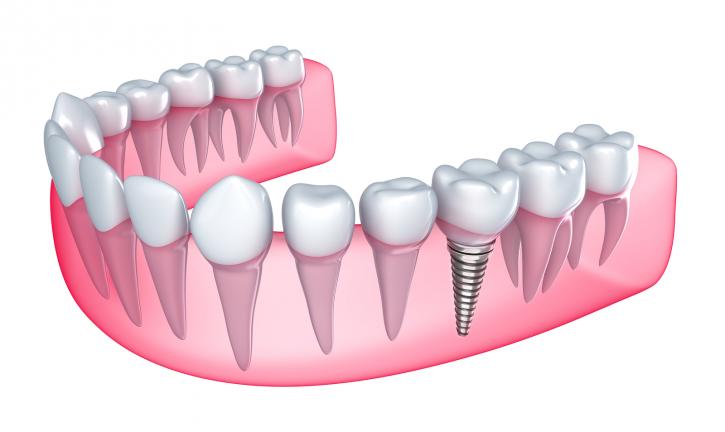 Image for Dental Implants in Ahmedabad with ID of: 1640381