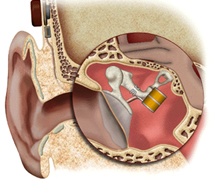 Image for Middle Ear Implants Market Forecasts up to 2024, Research Report - Coherent Market Insights with ID of: 1641918