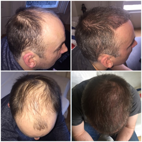 Image for Revive Hair Transplant Phoenix with ID of: 1650818