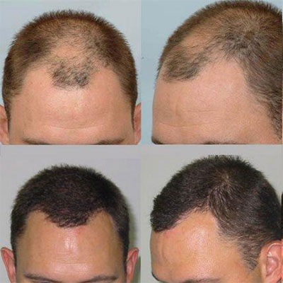 Image for Revive Hair Transplant Phoenix with ID of: 1650819