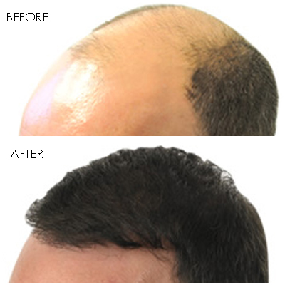 Image for Revive Hair Transplant Phoenix with ID of: 1650821