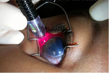 Image for Refractory Glaucoma Treatment Market Forecasts up to 2024, Research Report - Coherent Market Insights with ID of: 1661661