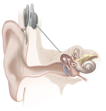 Image for Middle Ear Implants Market - Industry Analysis, Size, Share, Growth, Trends and Forecast to 2024 with ID of: 1679743