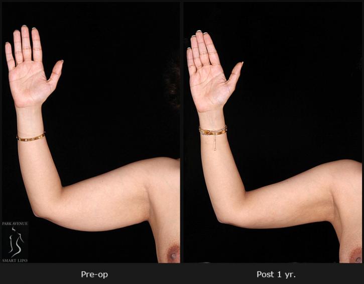 Image for How Arm Liposuction Improves Upper Arm Contour with ID of: 1690653