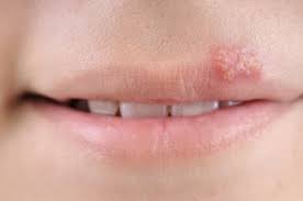 Image for Ultimate Cure For Herpes with ID of: 1729218