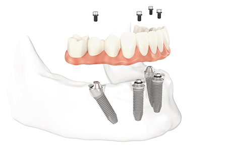 Image for Florida Smile Studio Coral Springs with ID of: 1733681