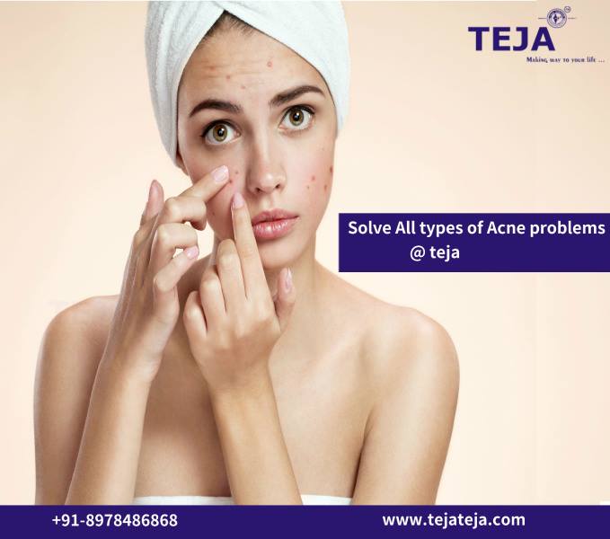 Image for Dark Spots Removal Treatment @ Teja's with ID of: 1751583