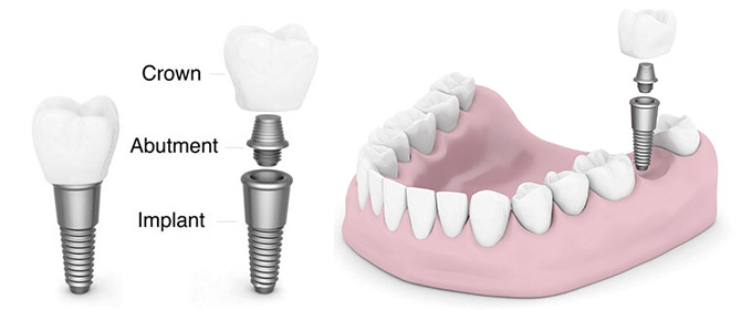 Image for Dental Implant Courses in India with ID of: 1757866