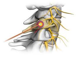 Image for Radiofrequency Ablation Market projected $696.5 Mn globally, by 2021, with 11.60% CAGR with ID of: 1819468